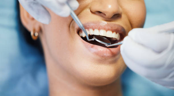 Best Knocked-Out Tooth (Avulsed Tooth) Treatment in Stratford Downtown, CT